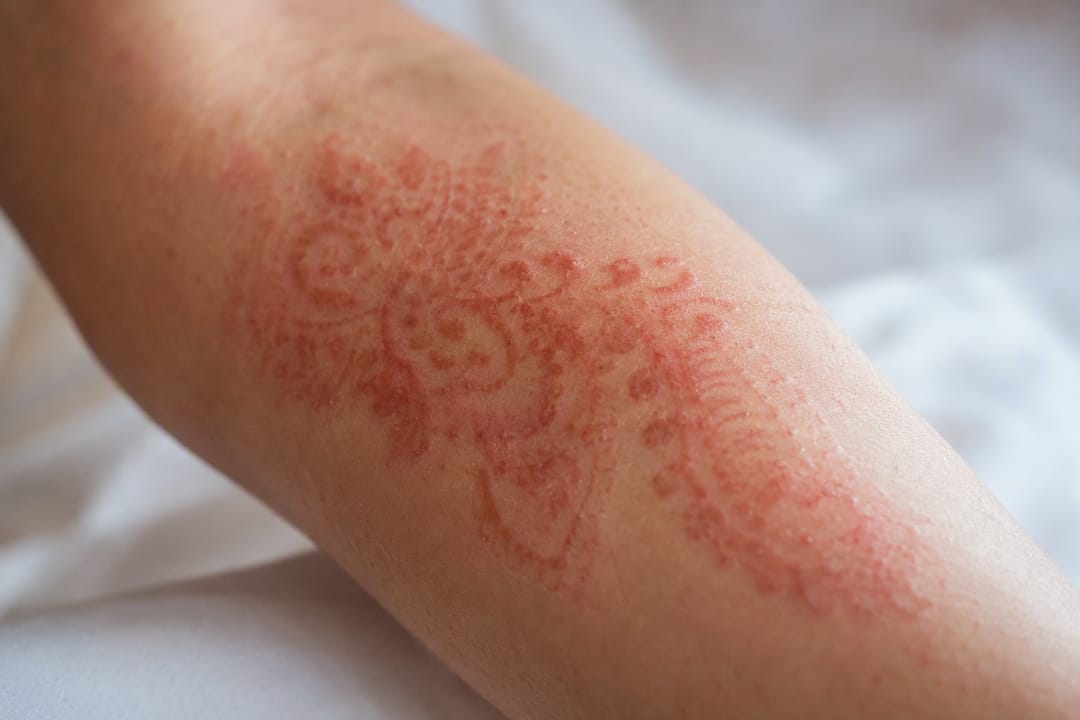 Red henna-shaped allergic skin rash