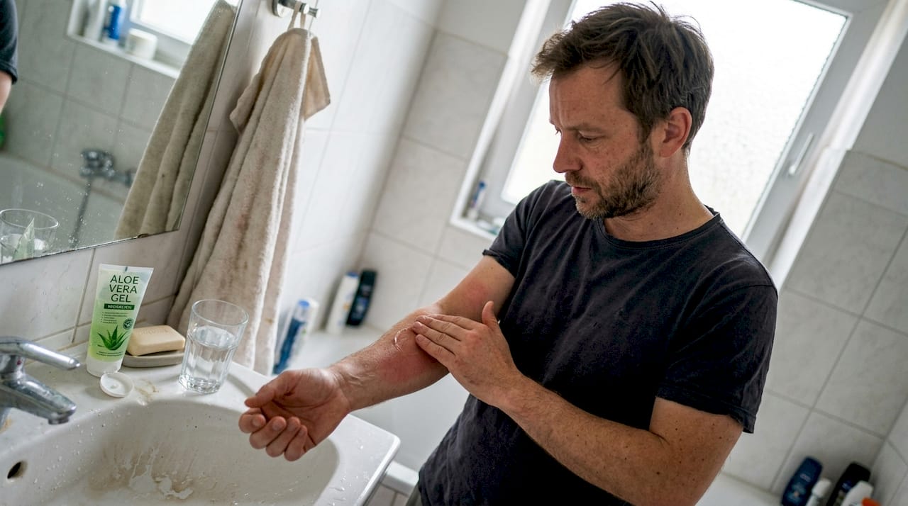 Ein Mann trägt Aloe-Vera-Gel auf seinen Unterarm auf.
