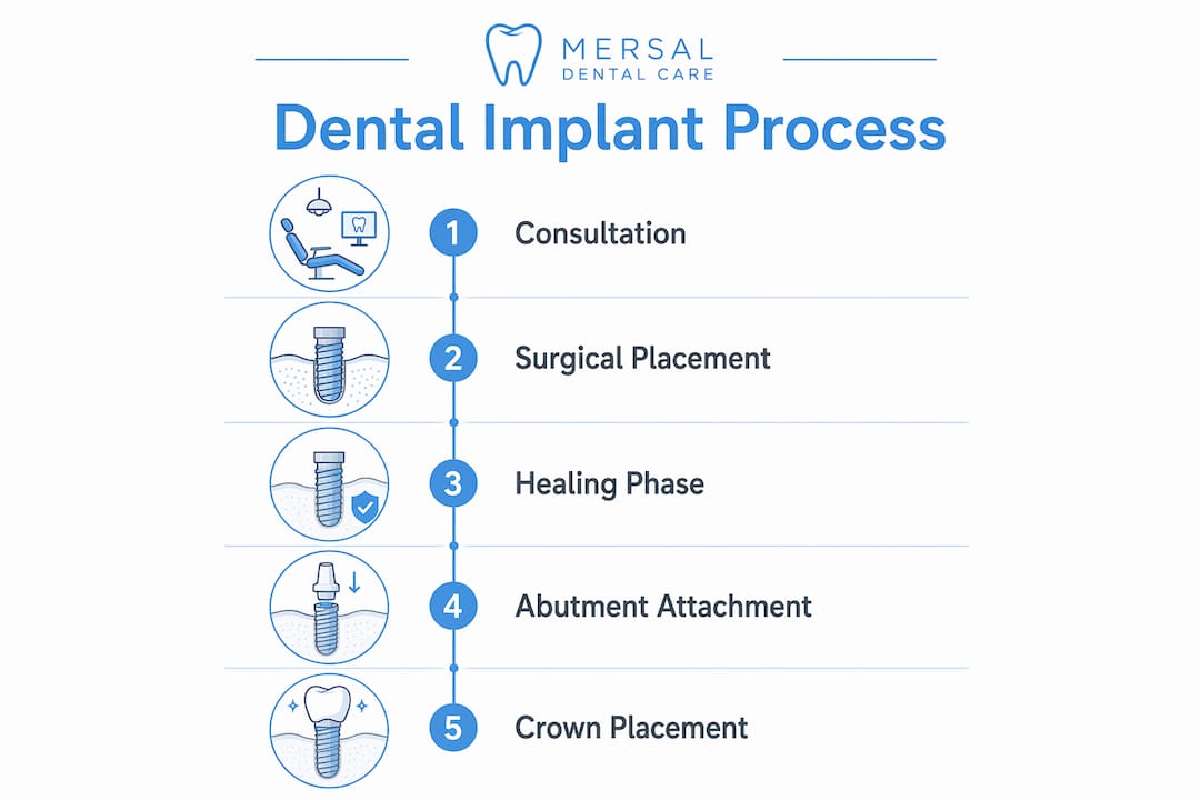 Infographic showing dental implant process steps