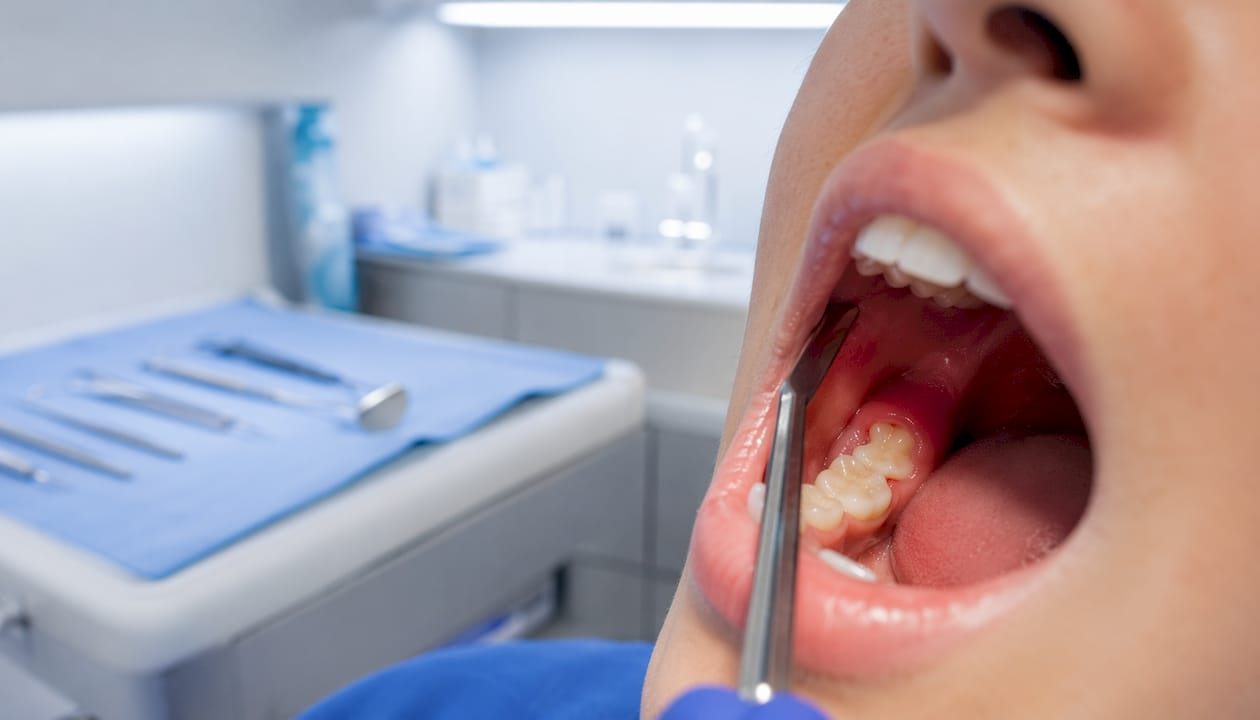 Close-up of infected gum around wisdom tooth
