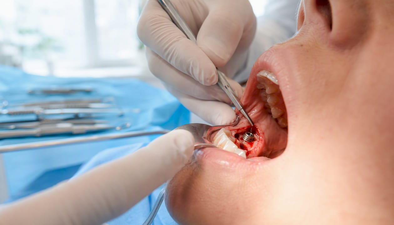 Close-up of healing dental implant site