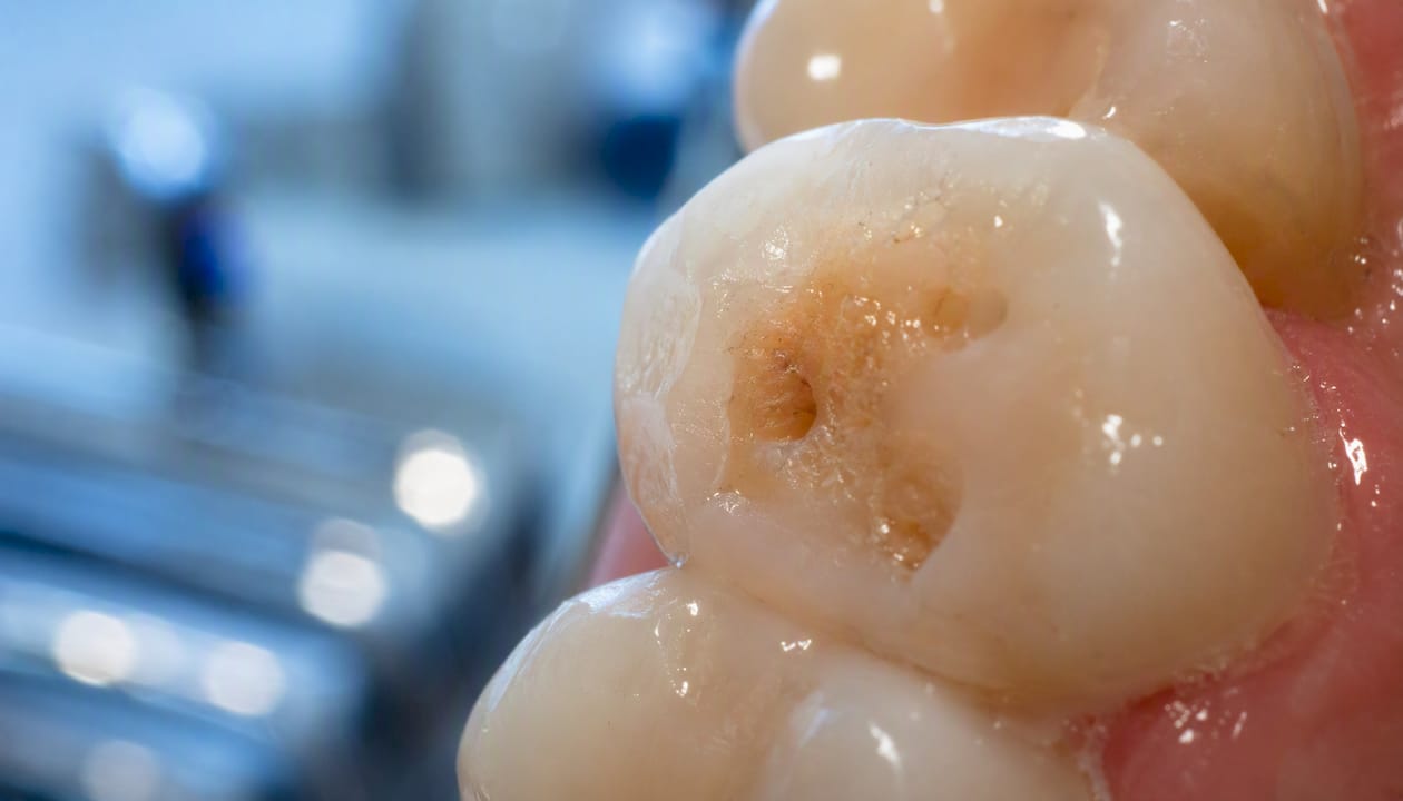 Close-up of enamel cavity with rough surface