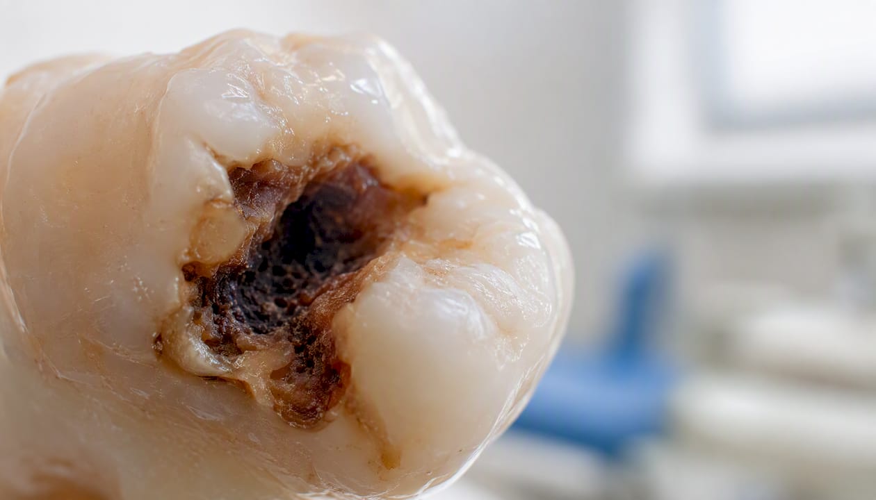 Molar tooth with dark dentin cavity close-up