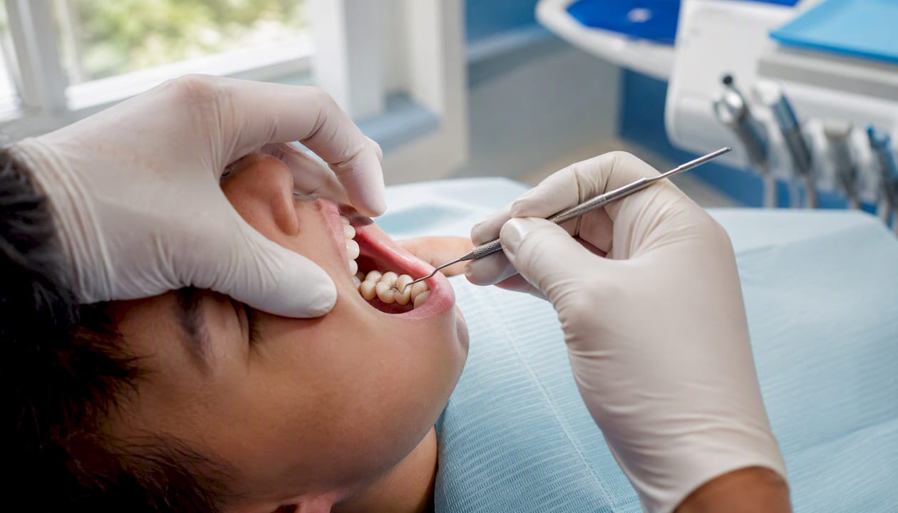 Dentist examining cracked molar tooth close-up