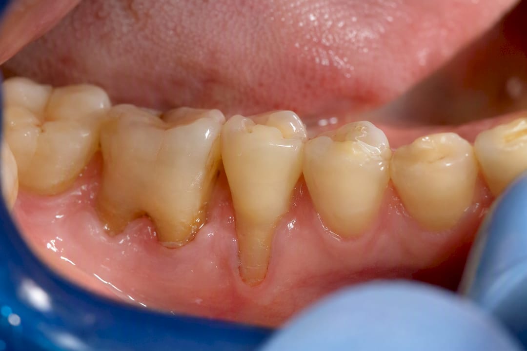 Exposed tooth root with gum recession