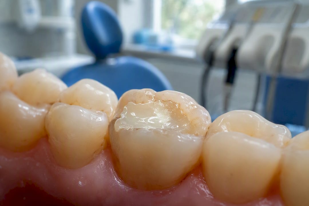 Glass ionomer filling near tooth gumline