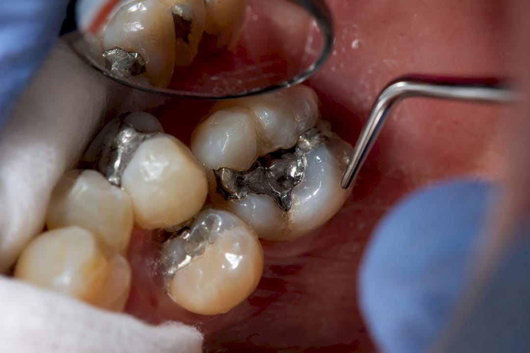 Molar tooth with silver amalgam filling