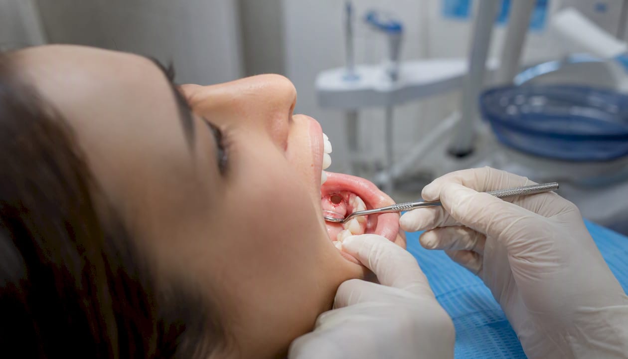 Clean dental extraction socket healing