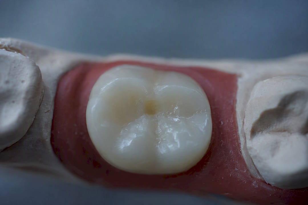 Close-up dental crown high spot