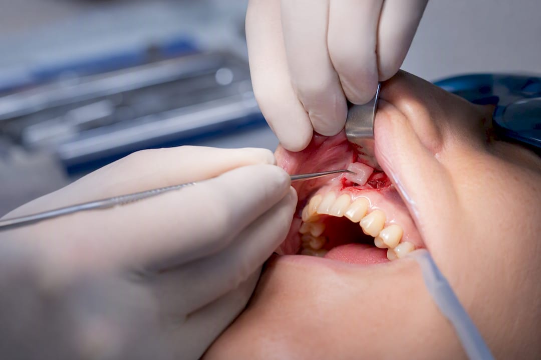 Dentist performing connective tissue graft surgery