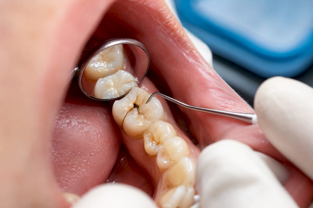 Close-up of a visibly fractured tooth