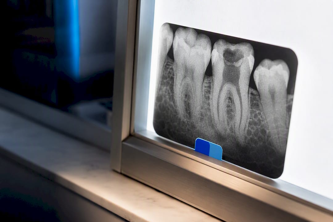 Molar dental X-ray on illuminated panel