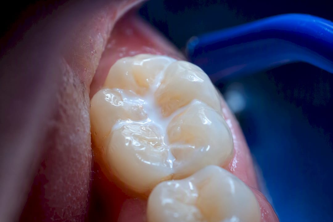 Dental sealant covering molar grooves