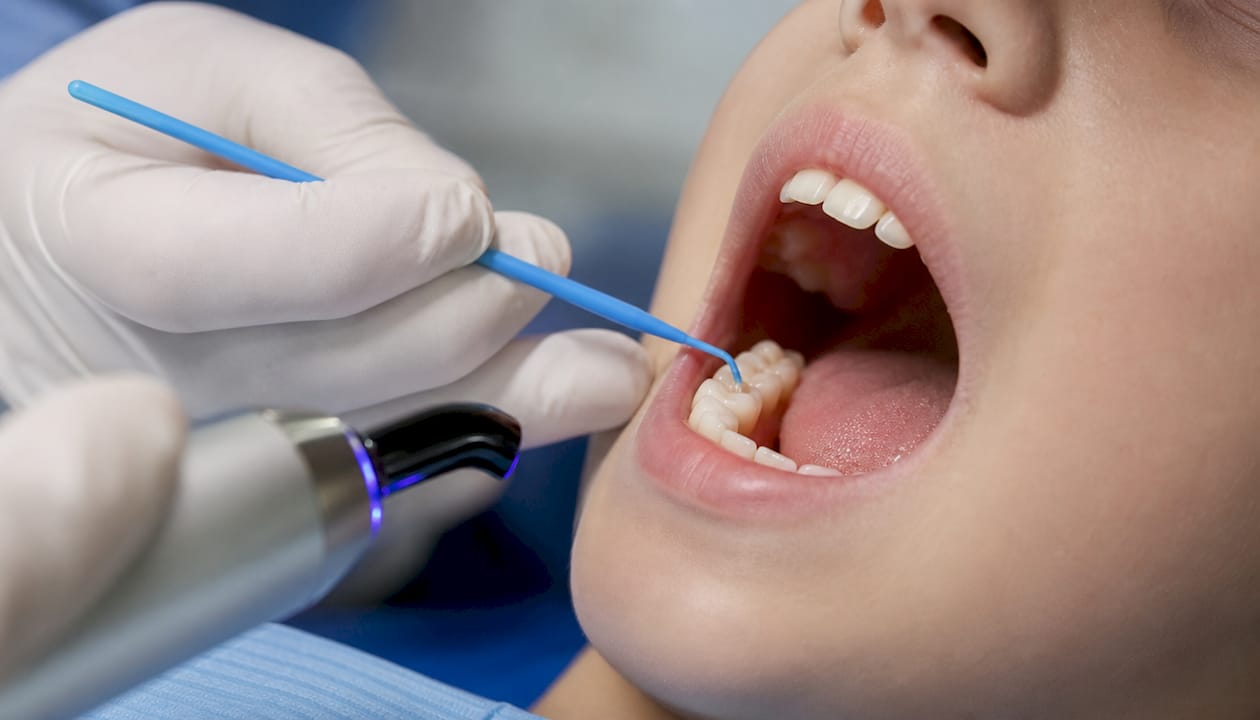 Dentist applying sealant to child molar