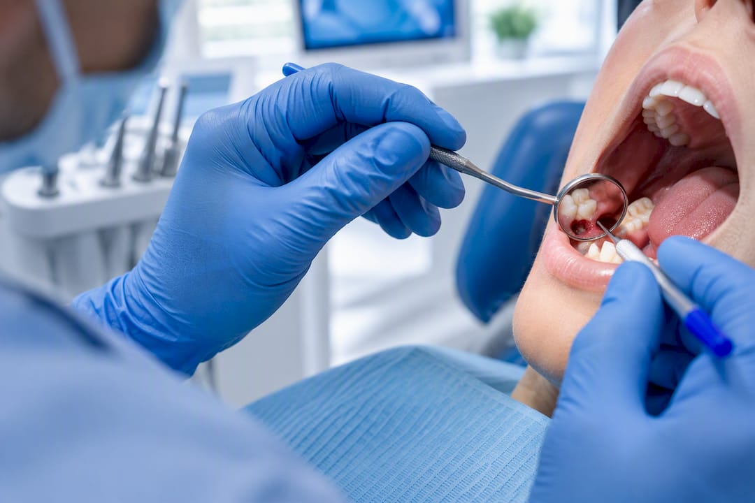 Dentist examining a post-extraction socket