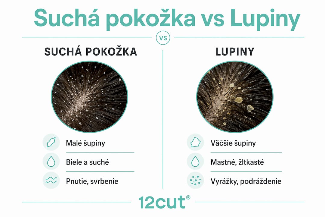 Prehľadná infografika, ktorá vysvetľuje rozdiely medzi suchou pokožkou hlavy a tvorbou lupín