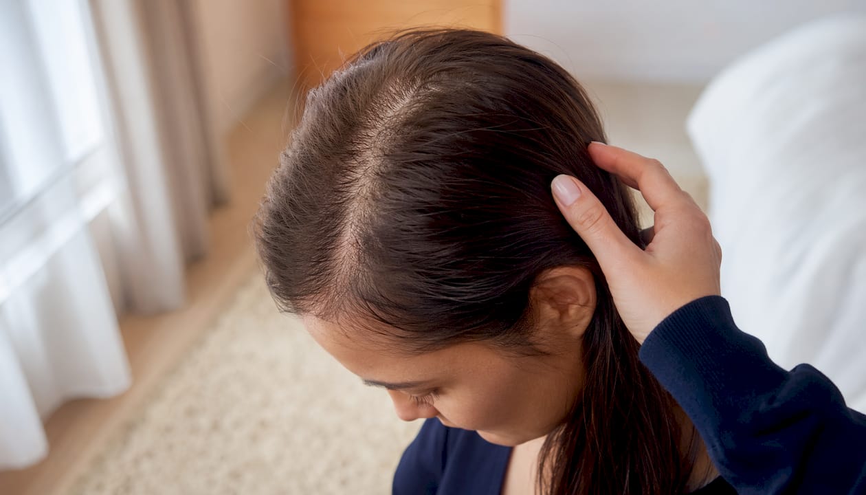 Close-up scalp showing female pattern hair thinning
