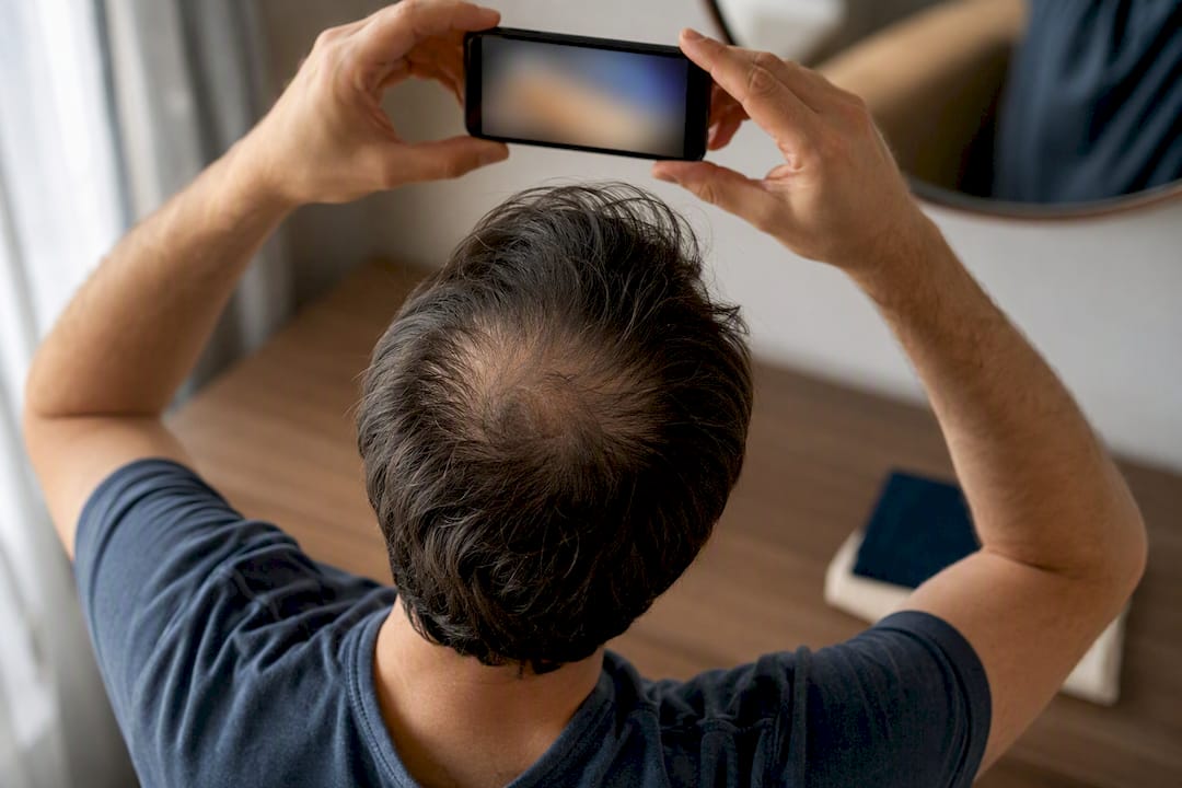 Person documenting scalp changes with phone