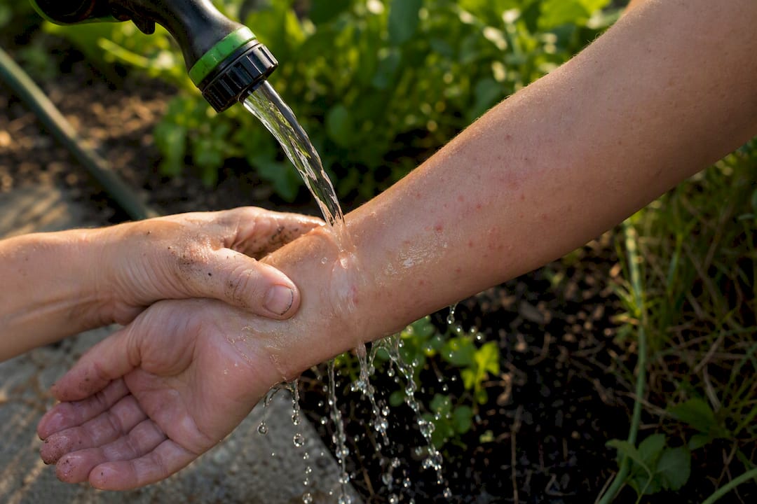 Hands washing chigger bites on forearm outdoors