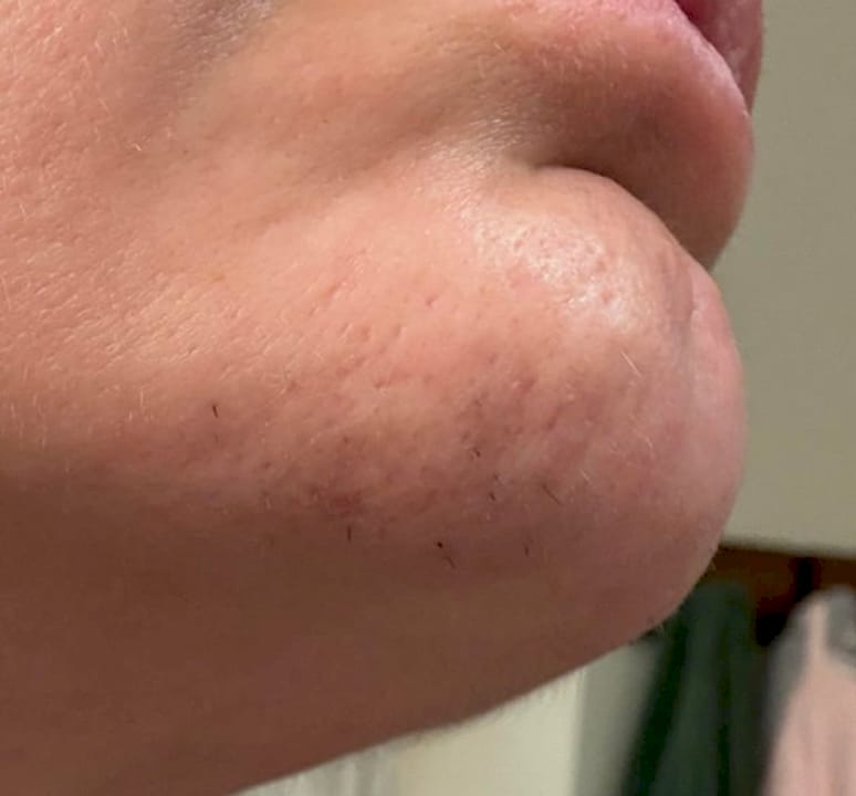 7 months electrolysis for chin hair