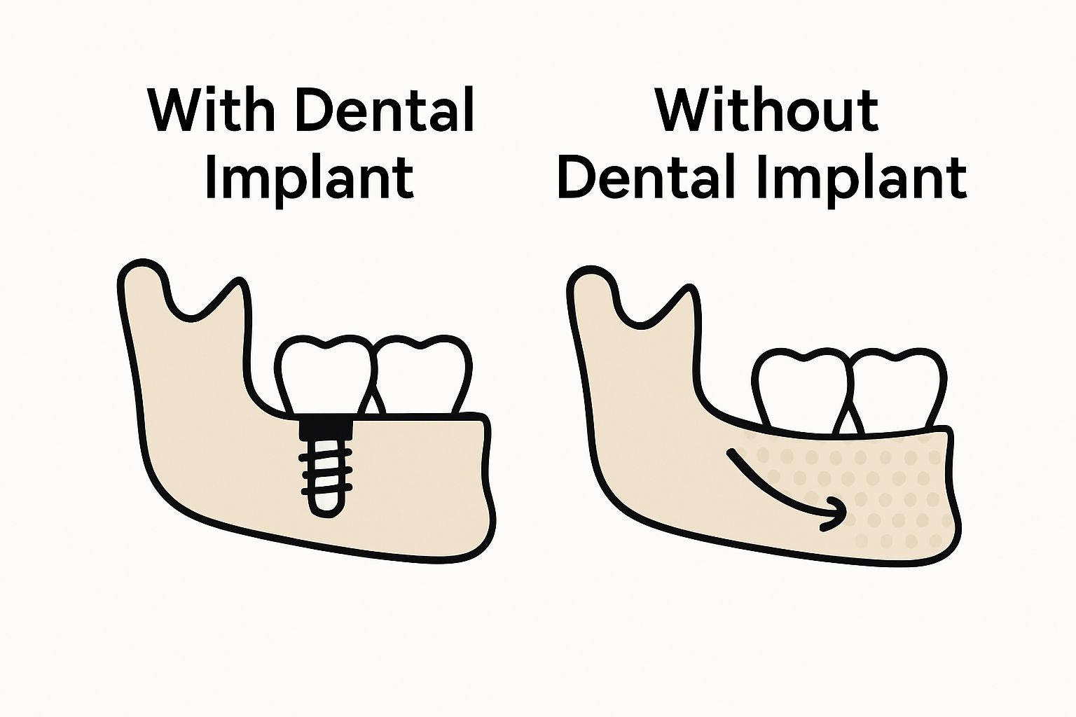 Infographic comparing jawbone with and without dental implant