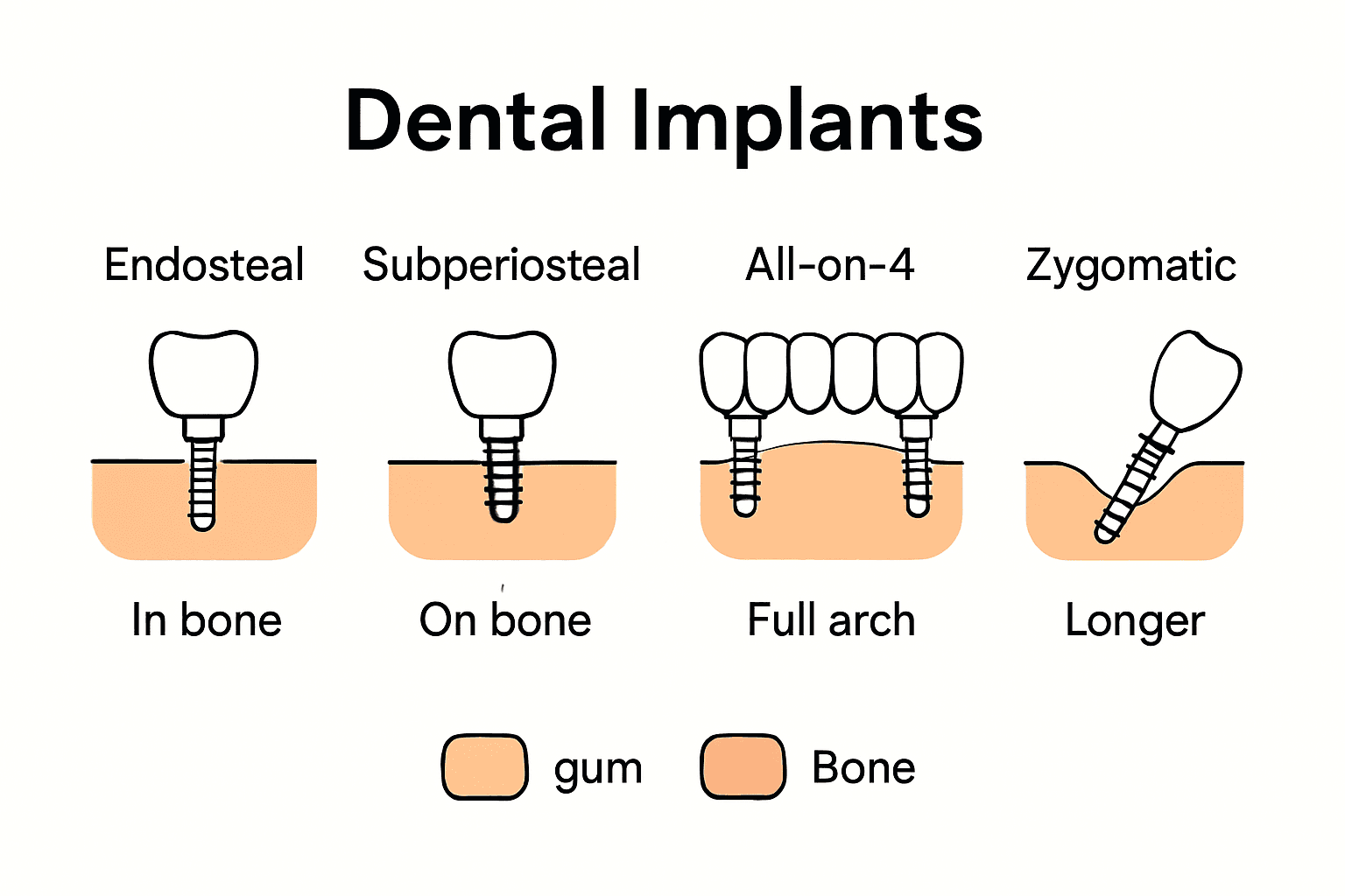 Infographic comparing four dental implant types and placements