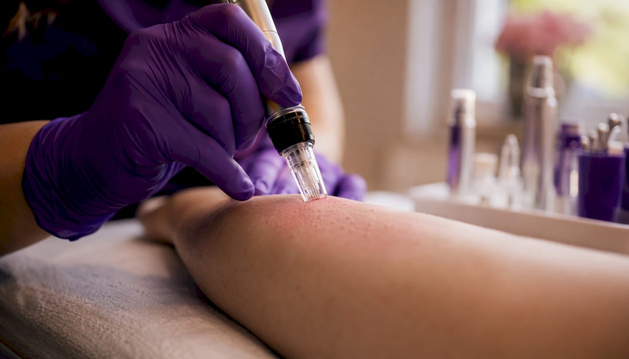 Close-up microneedling needle penetration on skin