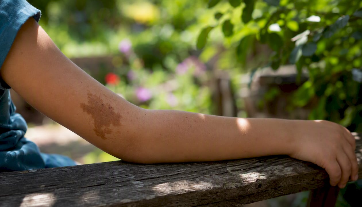 Close-up of child's birthmark on arm