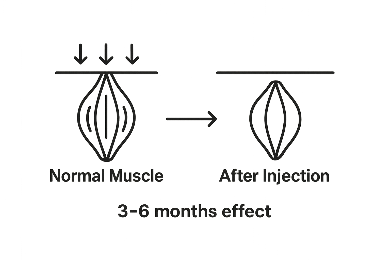 Understanding the Anti-Wrinkle Injection Guide 1 Comparison of muscle before and after anti-wrinkle injection with timeline