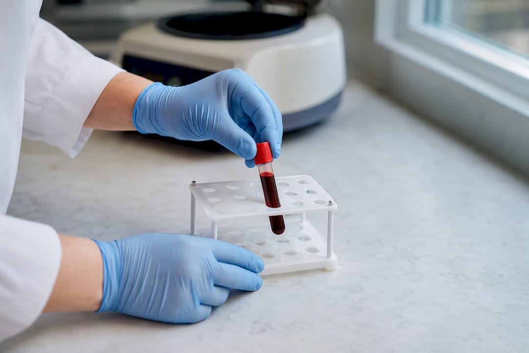 Blood sample being prepared for vitamin D testing