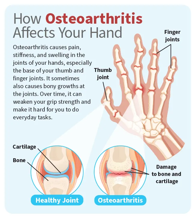Hand Osteoarthritis: Symptoms, Treatments, Remedies, and Prevention