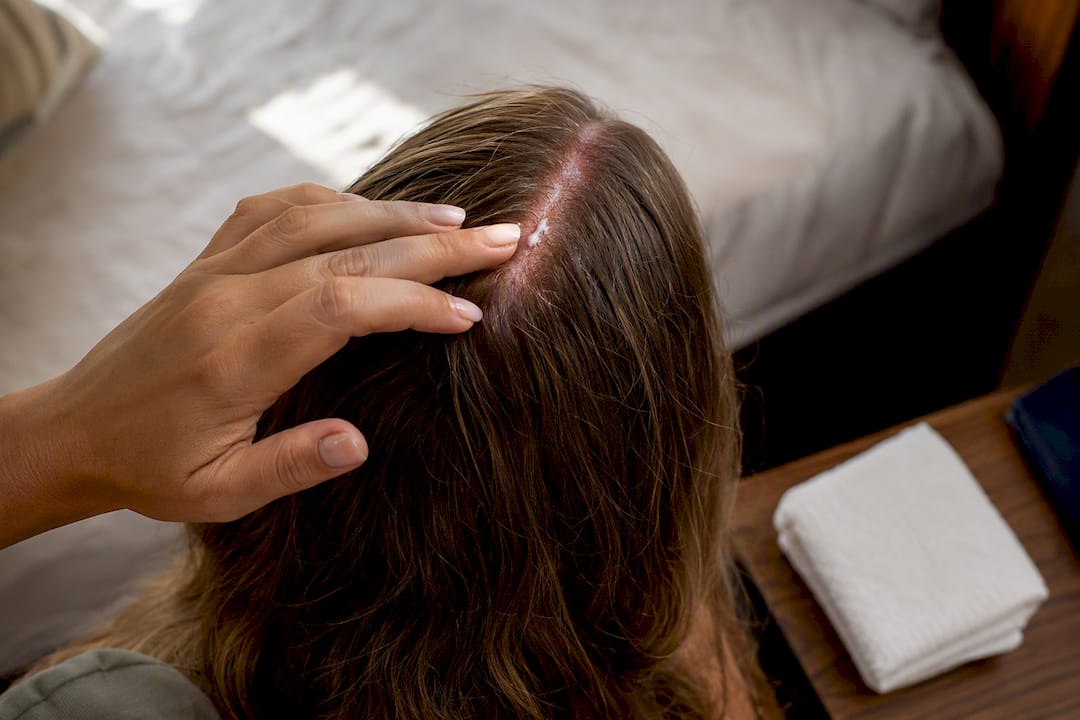 Thin cream applied to irritated scalp