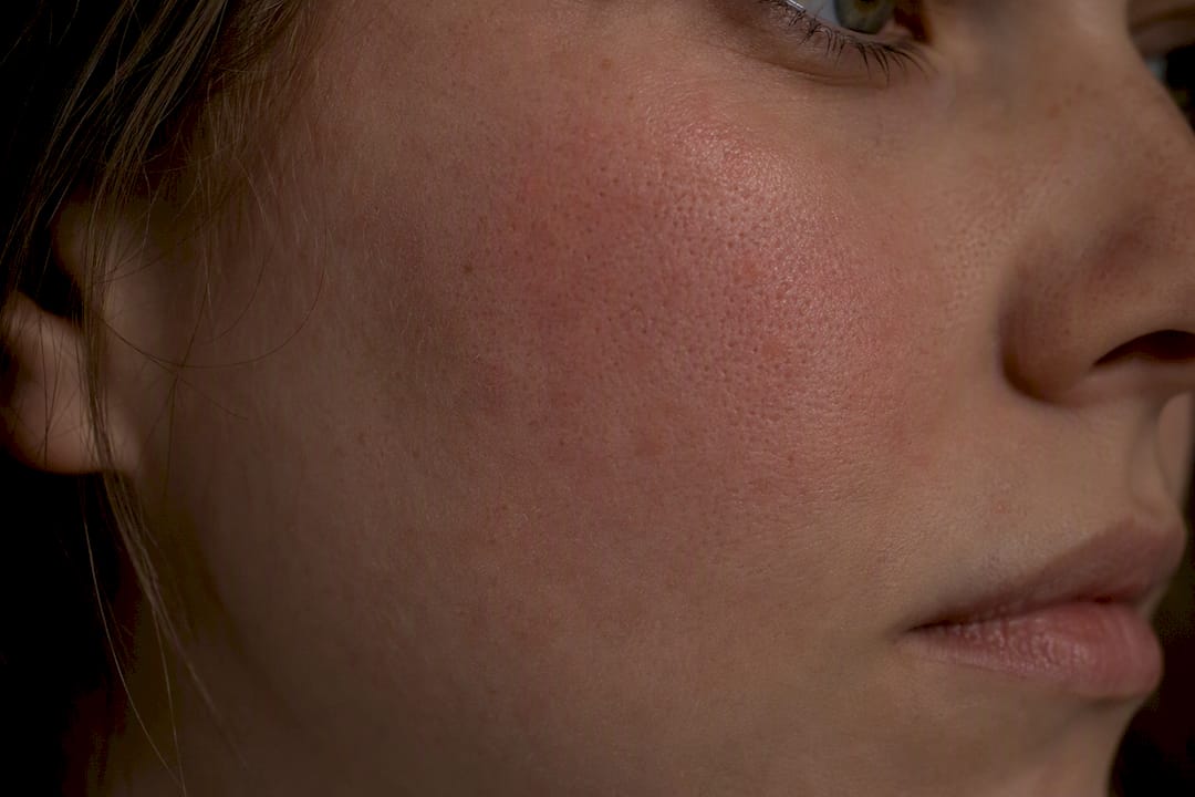 Close-up of mild skin redness and sensitivity