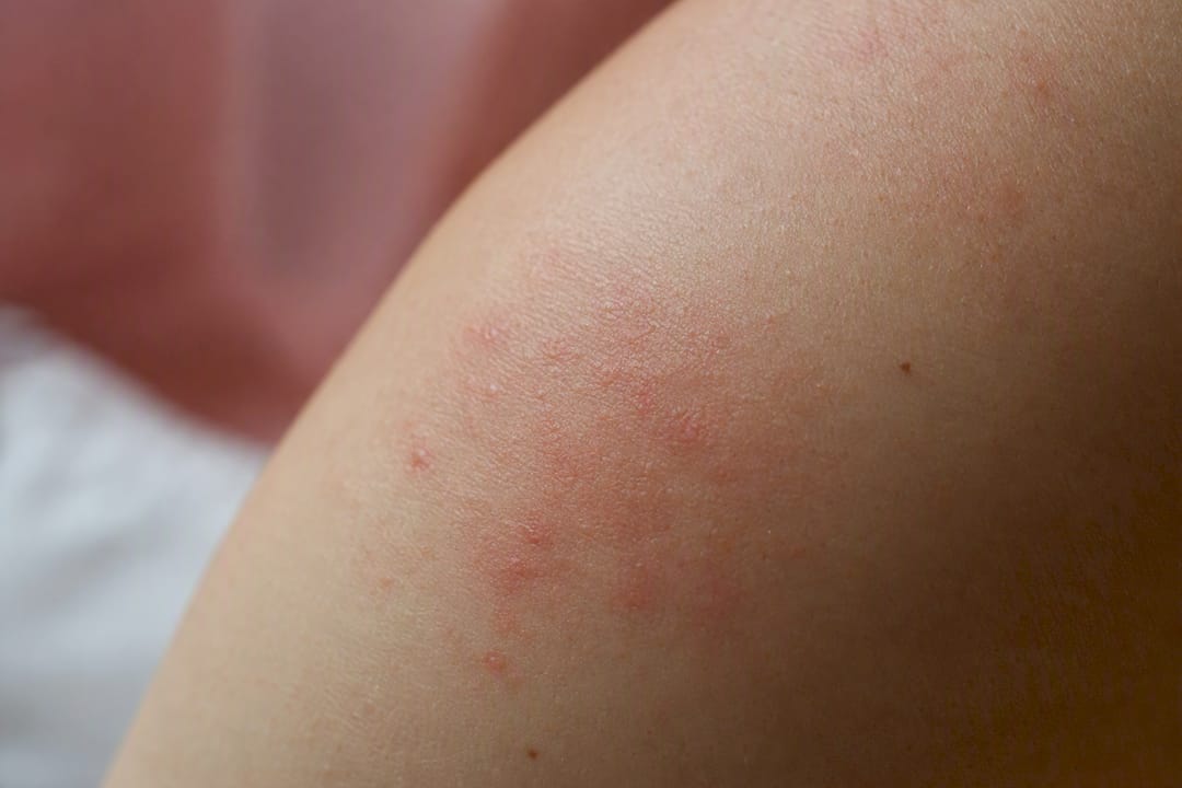 Close-up of irritated reddened skin from patch test