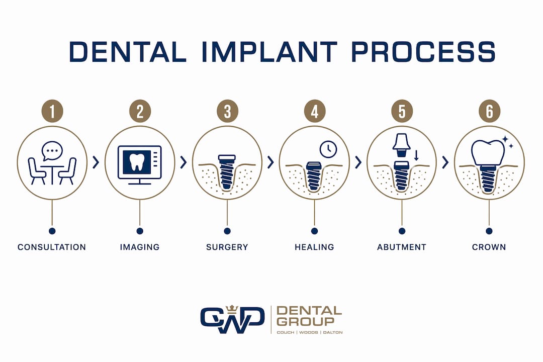 Infographic illustrating dental implant process steps