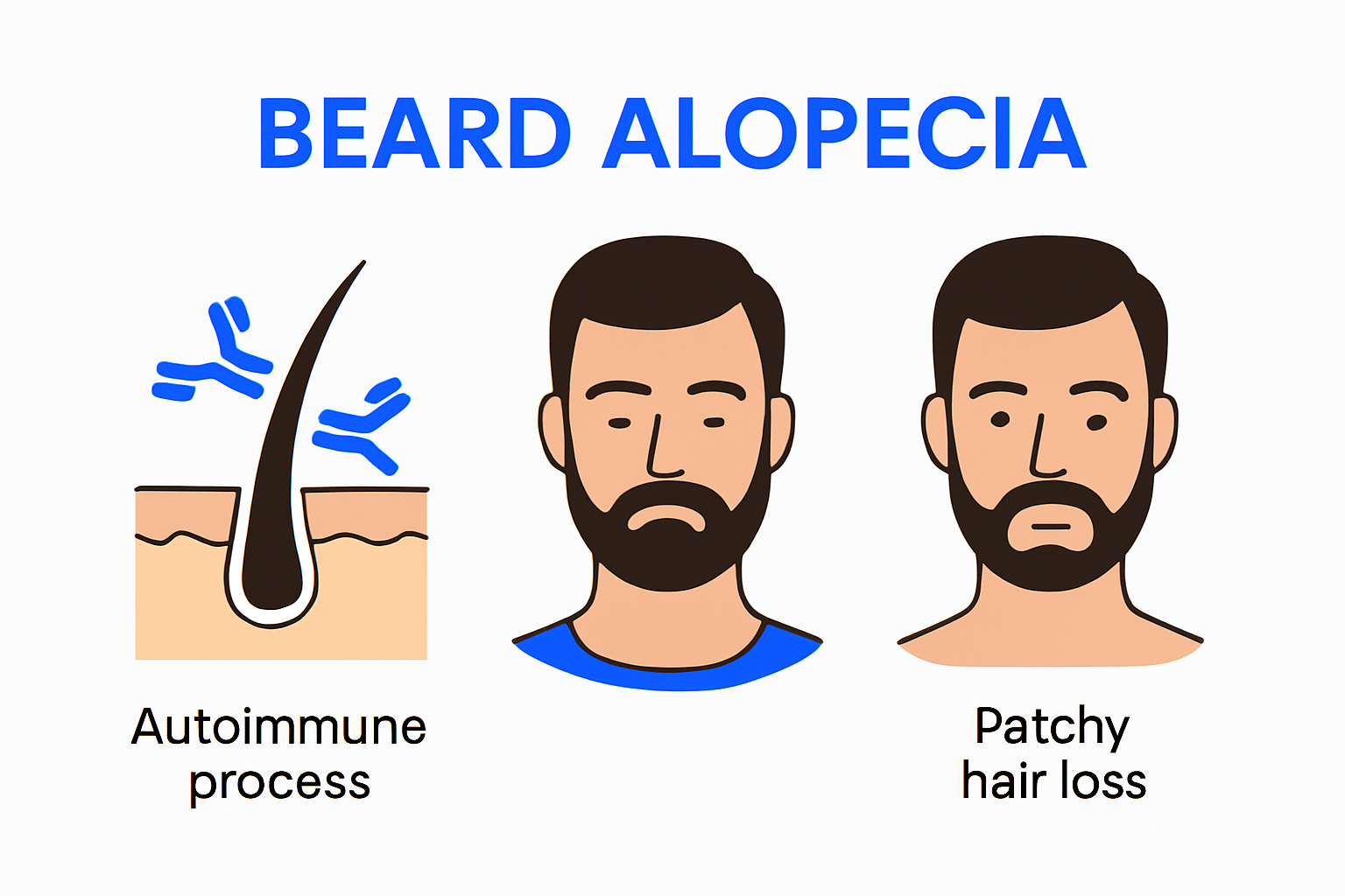 Diagram of beard alopecia causes and symptoms