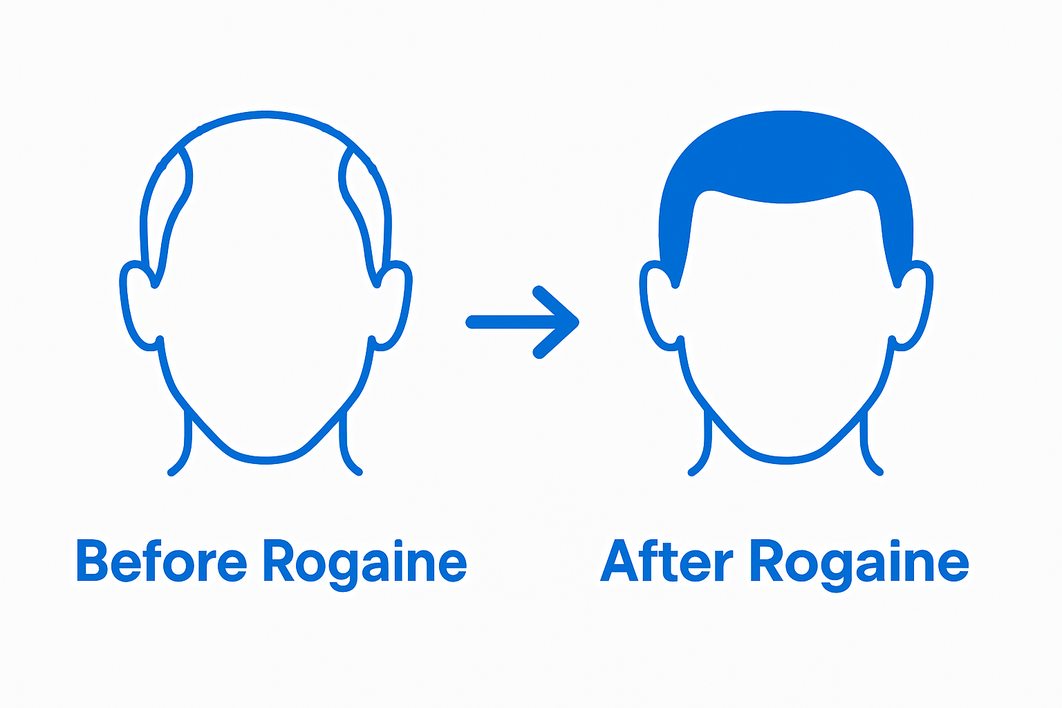 Simple before and after receding hairline using Rogaine