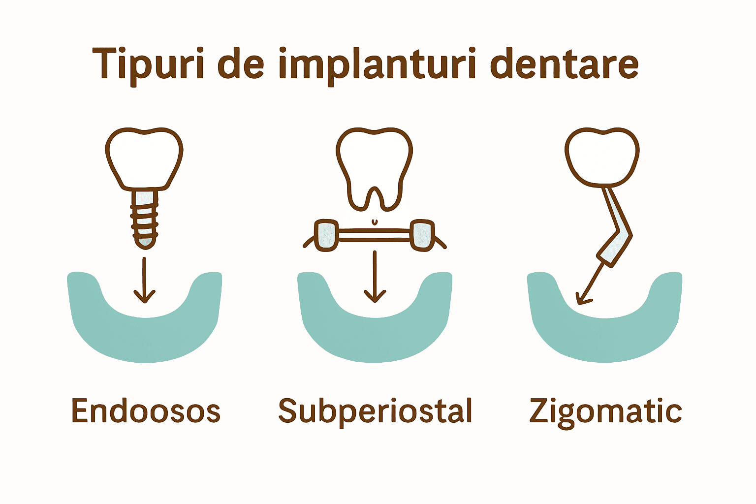 Infografic care compară tipurile de implanturi dentare