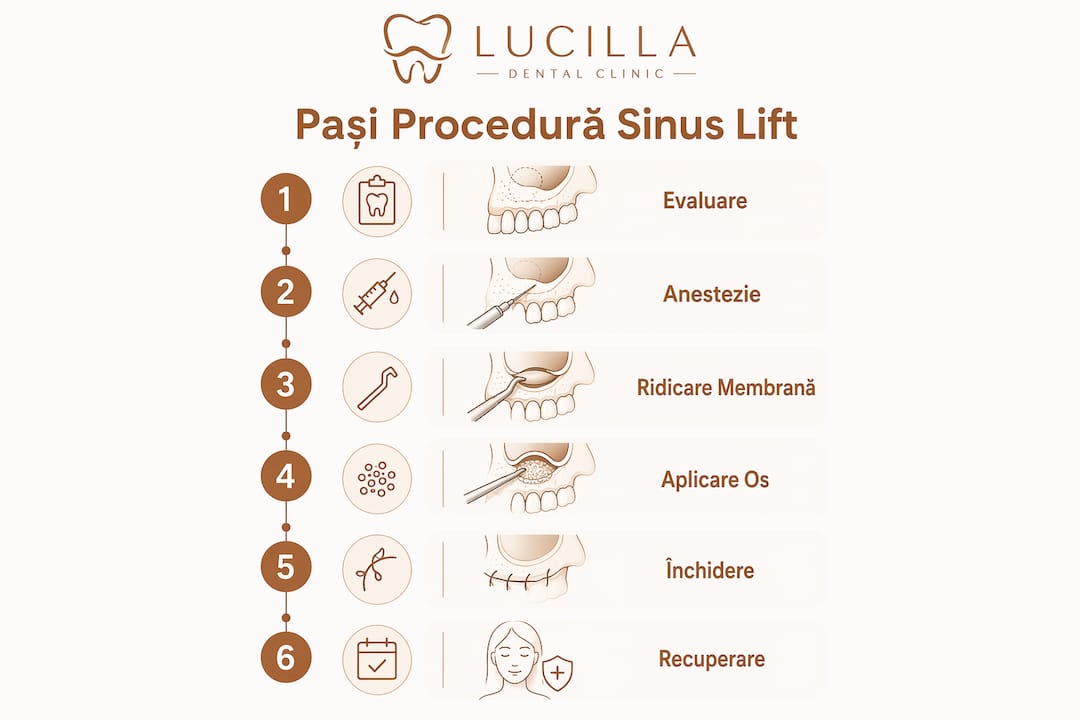 Infografic cu pașii necesari pentru realizarea procedurii de sinus lift