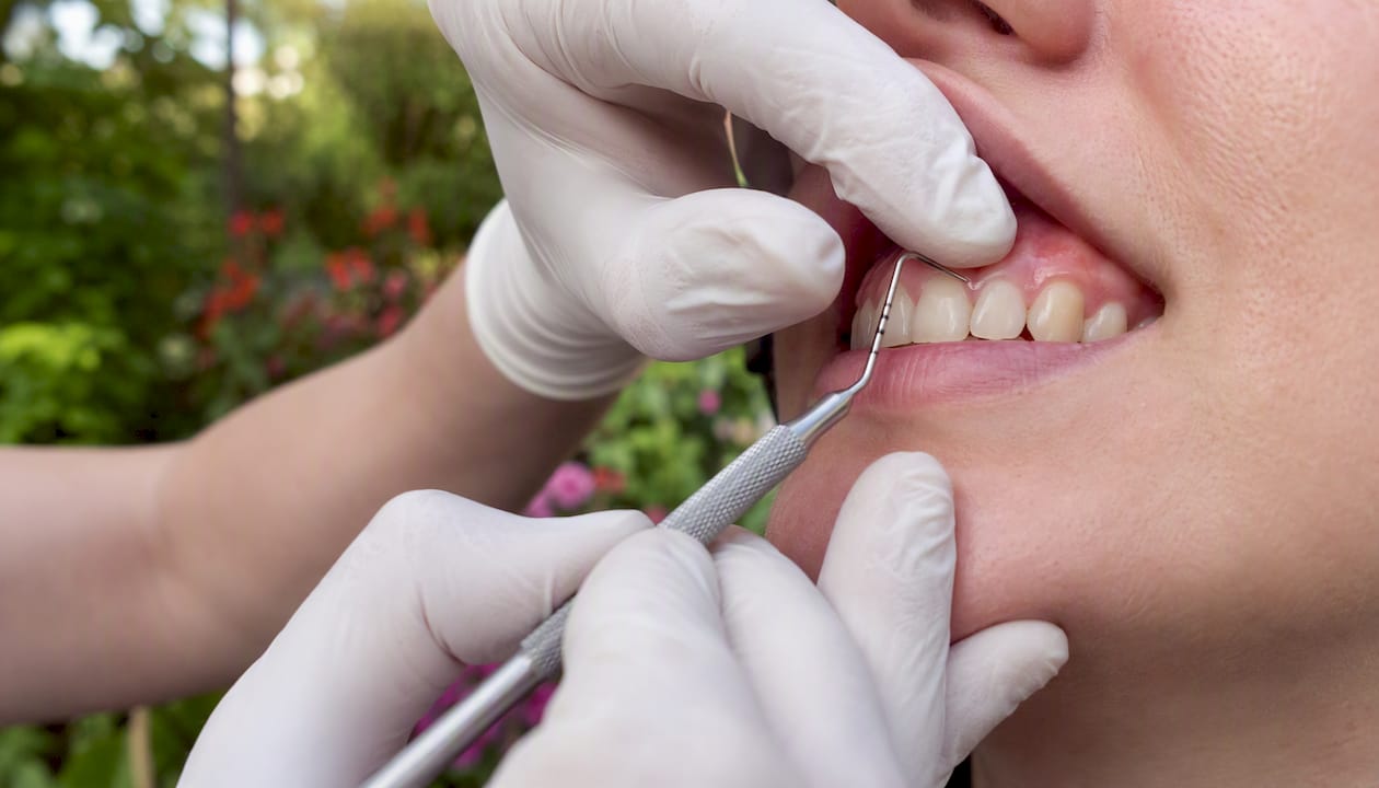 Dentist measuring gum recession with probe