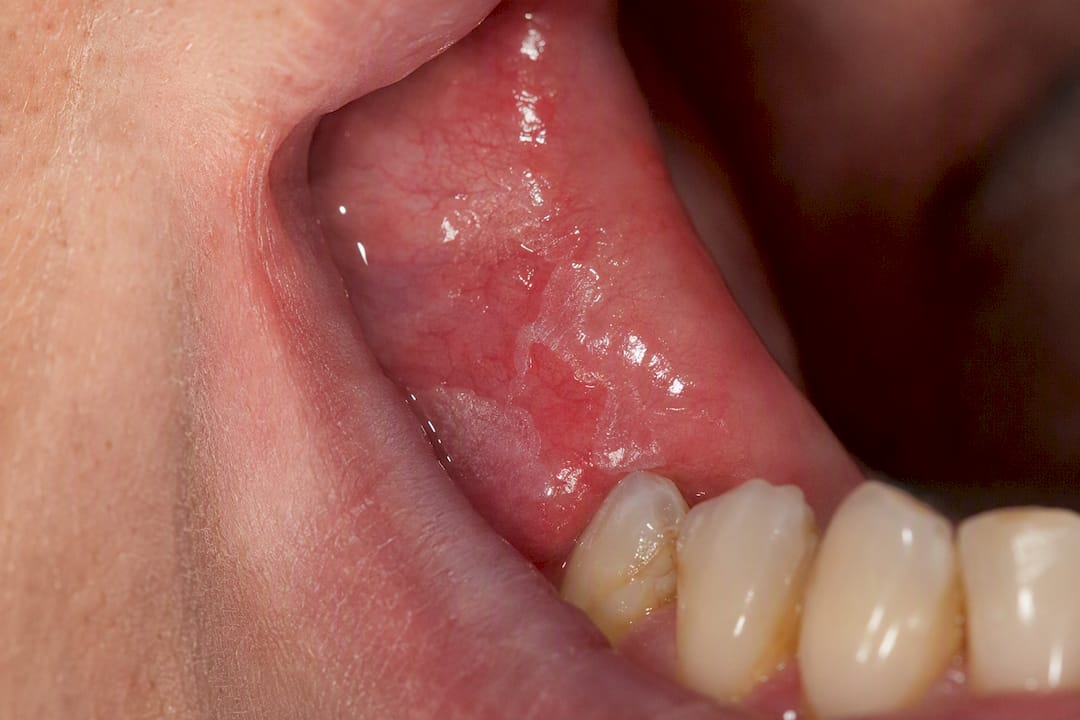 Inflamed oral tissue showing stomatitis symptoms