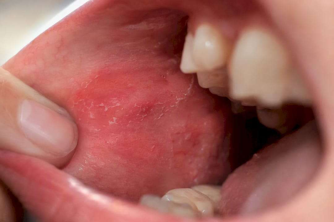 Close-up of irritated oral mucosa tissue