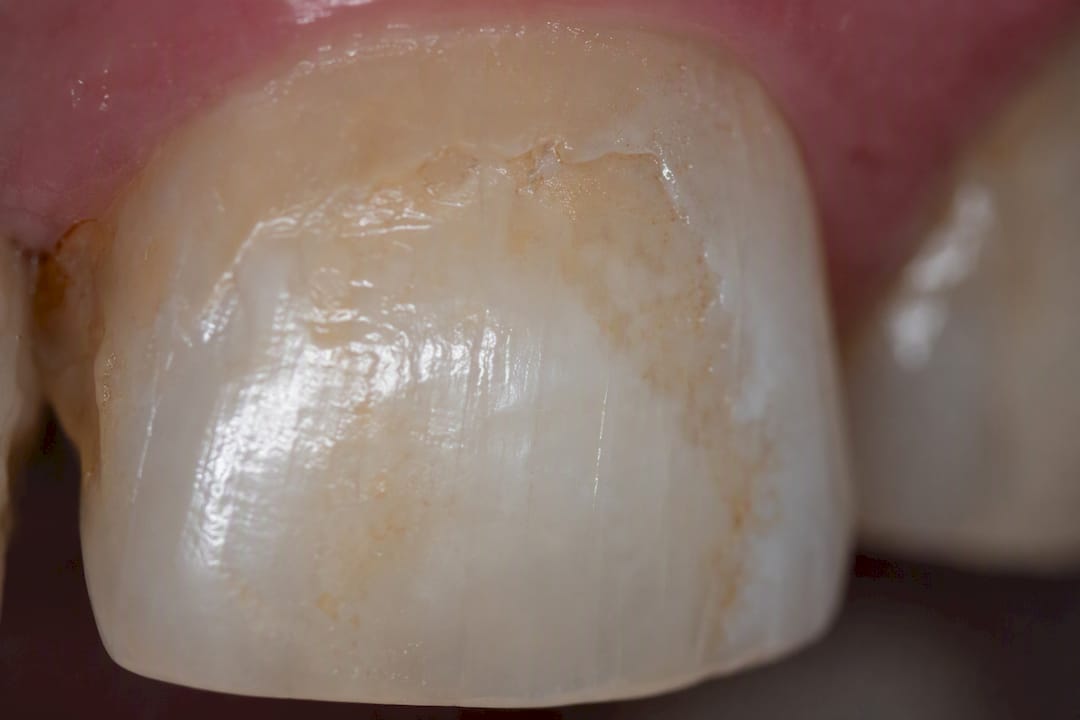 Close-up of tooth enamel erosion