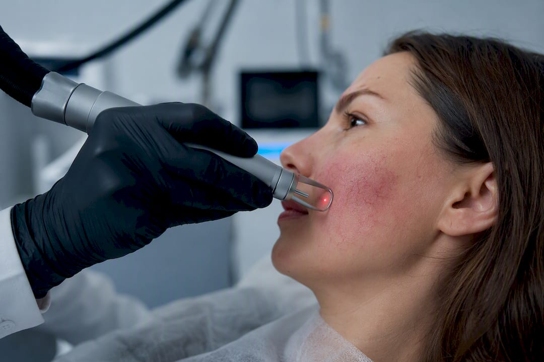 Piesă de mână laser care țintește vasele de sânge de pe față