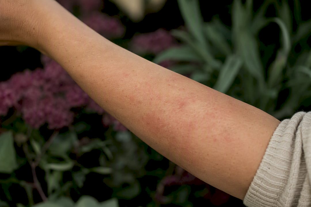 Close-up of arm showing mild skin redness