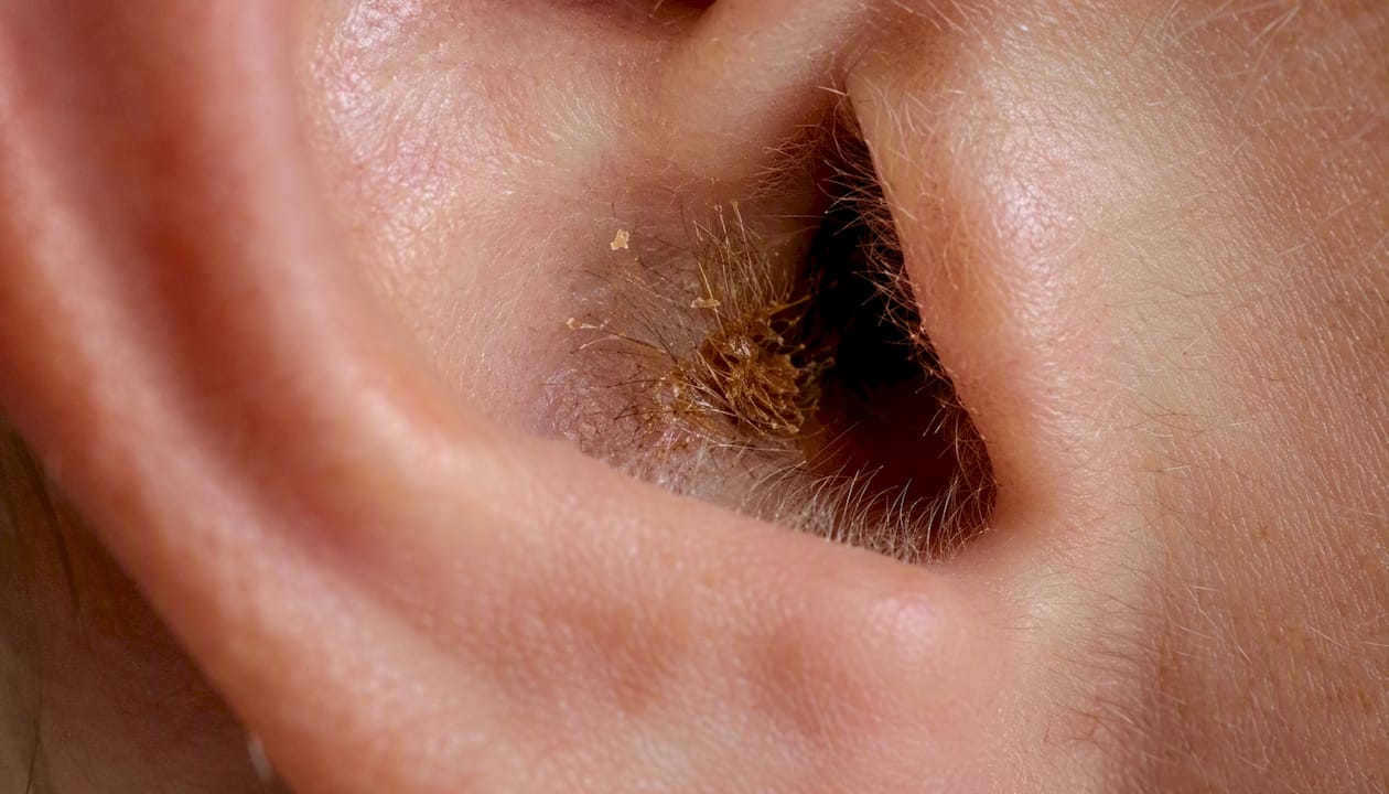 Close-up of ear canal entrance with wax buildup