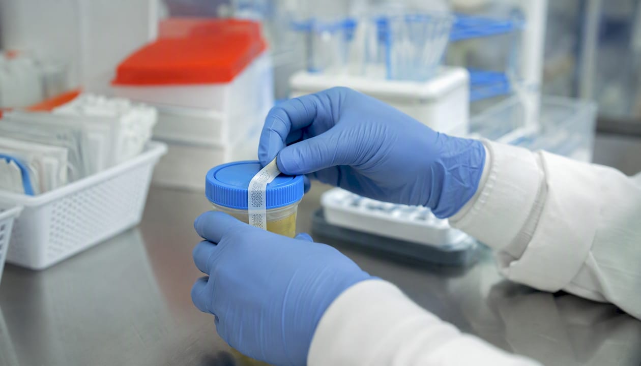 Hands sealing drug test specimen cup