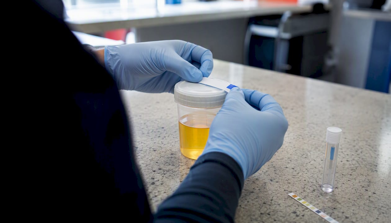 Hands sealing urine collection cup with tamper-evident label