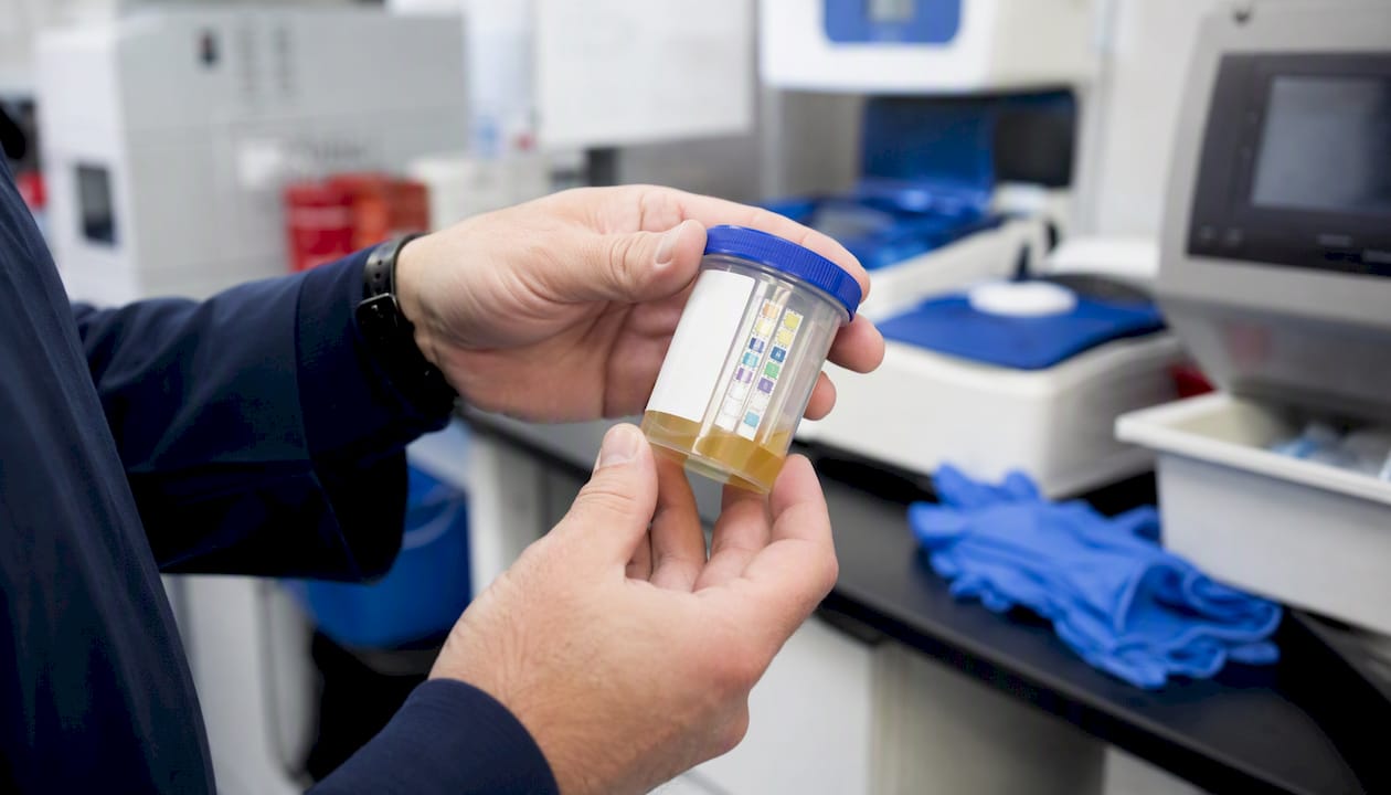 Hands holding urine cup with SVT pads